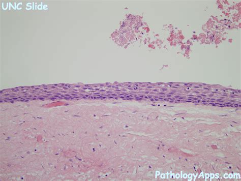 dentigerous cyst pathology