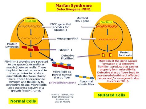 Genetics Marfan Syndrome Connective Tissue Genetic Disease Detection ...