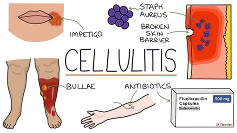 Cellulitis Causes