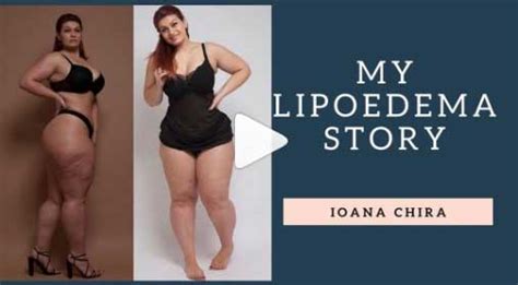 Instagram Fitness Star Ioana Chira (Ioana_Fit) on Living with Lipoedema