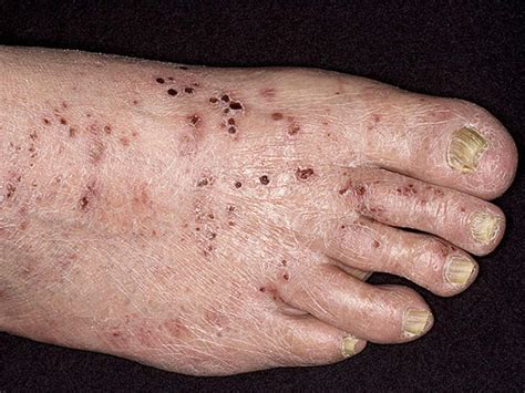 Is it shingles? 7 myths about painful illness (graphic images) - CBS News