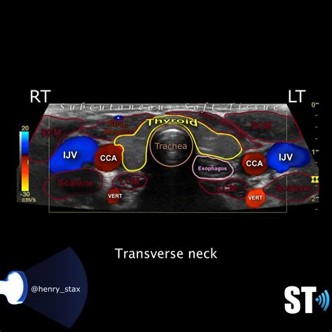 Thyroid Ultrasound Protocol – Sonographic Tendencies