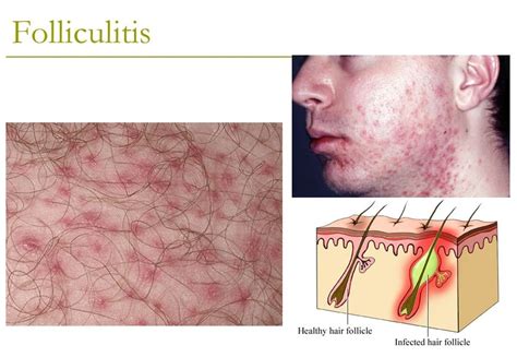 Folliculitis On Face Treatment - Doctor Heck