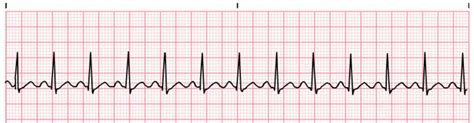 Sinus Tachycardia training - video | ProCPR