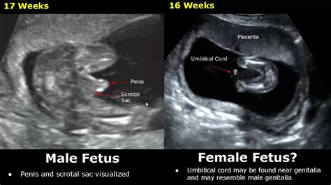 Fetal Gender Determination On Ultrasound | Determining The Sex Of A ...