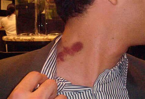 How Long Do Hickeys Last, Hickey Pictures, Definition, are they Bad ...