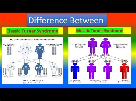 Turner Syndrome: What It Is, Causes, Symptoms Treatment, 57% OFF