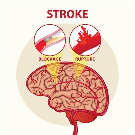 Premium Vector | Stroke Day Brain Illustration Design