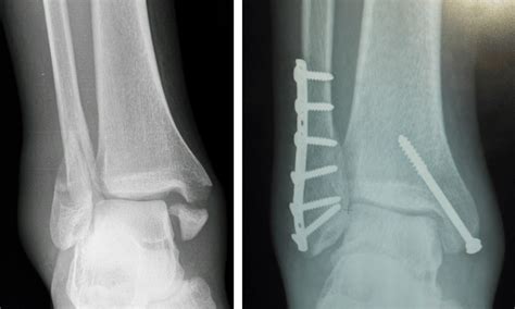 Tibia and Fibula Fractures - Management - Reduction - TeachMeSurgery