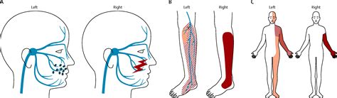 Allodynia and hyperalgesia in neuropathic pain: clinical manifestations ...