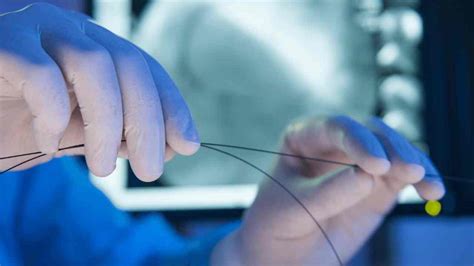 Stent Placement Symptoms: What to Watch For