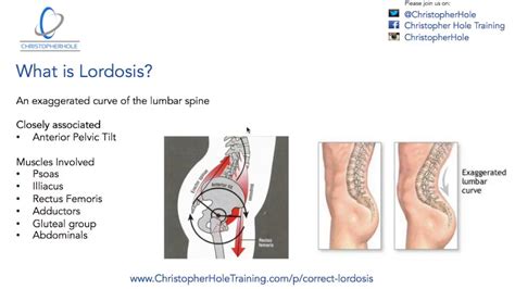 Lordosis Treatment: A 3 Step Process - YouTube