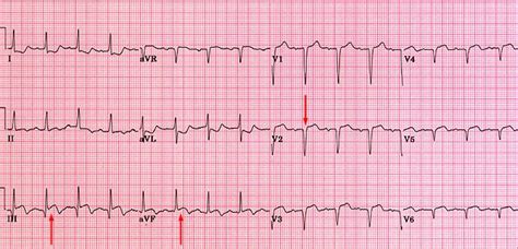 Step 8: Assess Q waves and determine significance