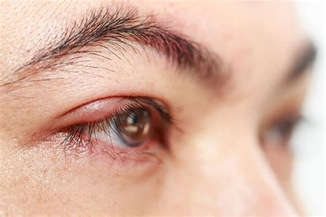 Treatment and Symptoms of a Stye on the Eyelid