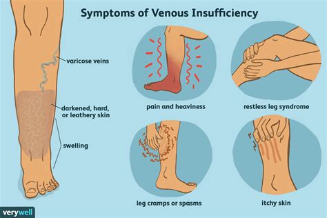 Stages Of Chronic Venous Insufficiency - TDPel Media