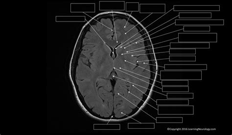 Approach to MRI brain | LearningNeurology.com