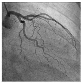 Mercy Angiography > Procedures & Treatments > Interventional Cardiology ...