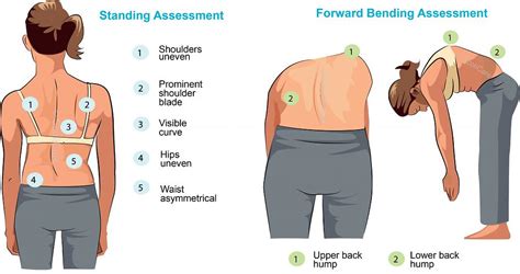 Scoliosis... the sideways spinal curve that could be causing your ...