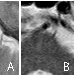 Small deep pontine infarct (SDPI); A: Axial T2WI MRI of the brain shows ...