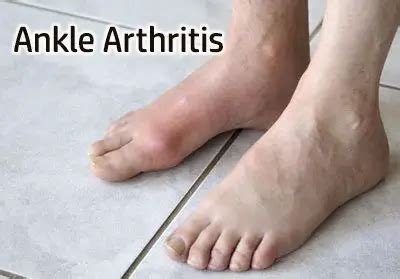 Arthritis In Ankle: Causes Symptoms and Treatment Options