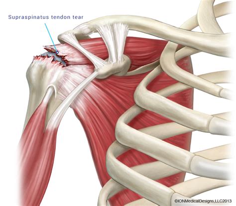 Rotator Cuff Tear - Joint Preservation Center