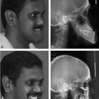 Composite picture of patient 2 who underwent a Kufner modification of ...