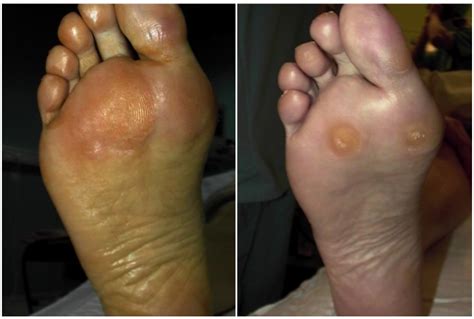 Metatarsalgia – Foot and Ankle Institute