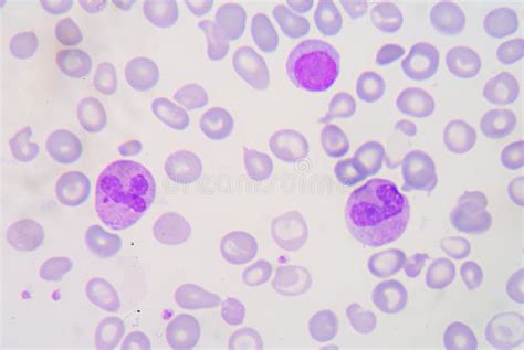 Blood Smear Beta Thalassemias (β Thalassemias) Are A Group Of Stock ...