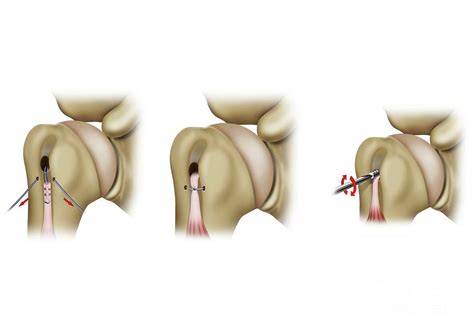 Tenodesis Shoulder Tendon Surgery Photograph by Maurizio De Angelis ...