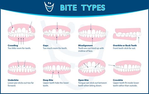 Understanding the different types of bites! | Dental assistant study ...