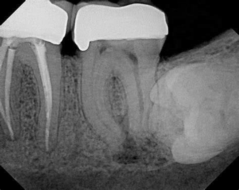 Periapical Periodontitis; Periodontitis, Apical; Periodontitis, Acute ...