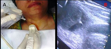 Evaluation of non-palpable thyroid nodules by ultra sound guided fine ...