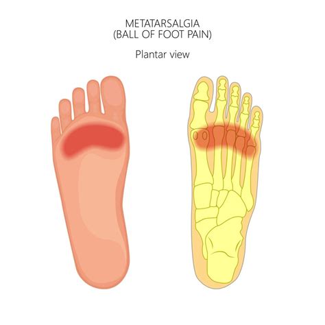 Metatarsalgia/Metatarsal Pain - Caruso Foot & Ankle