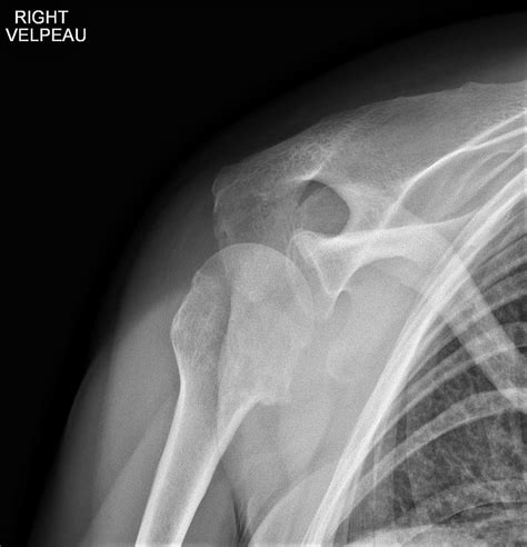 Shoulder Imaging - Shoulder & Elbow - Orthobullets