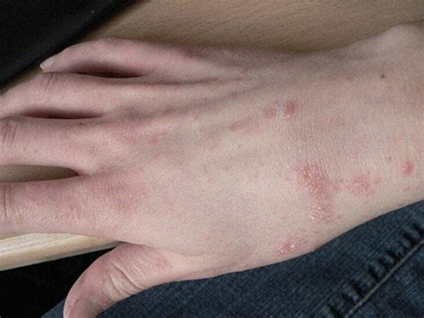 Rashes That Look Like Scabies: Causes, Symptoms, And, 55% OFF