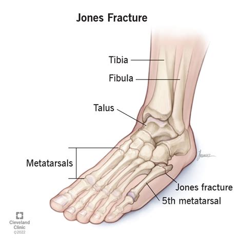 Metatarsal Fracture