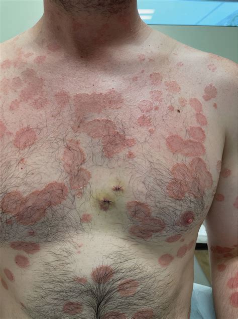 Painful and Pruritic Eruptions on the Entire Body | MDedge Dermatology