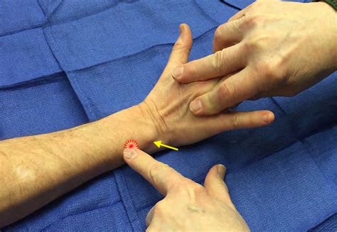 Extensor Carpi Ulnaris (ECU) Tenderness | Hand Surgery Resource