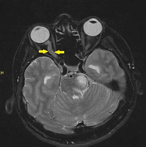 Optic Perineuritis in Neuromyelitis Optica Spectrum Disorder | Cureus