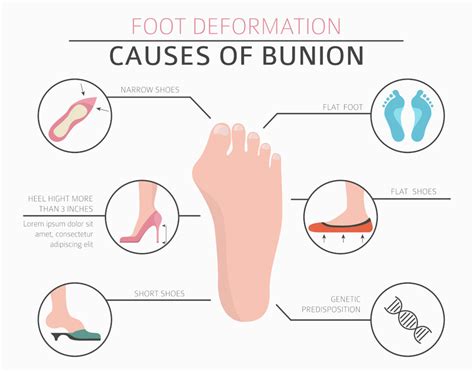 Is bunions treatment without surgery possible?