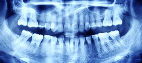 Do Adults Need Dental X-Rays | All Star Dental