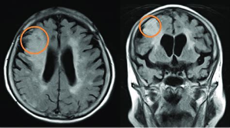 MRI revealed a high-signal intensity area in the right middle frontal ...