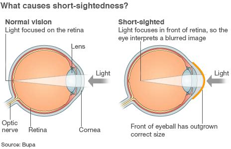 Farsighted (fixed w/converging lens) vs. nearsighted (fix w/diverging ...