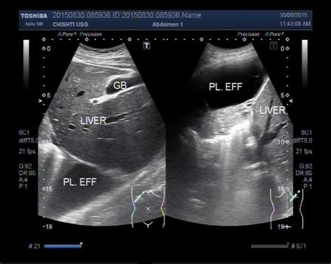 Pleural effusion | Medical ultrasound, Diagnostic medical sonography ...