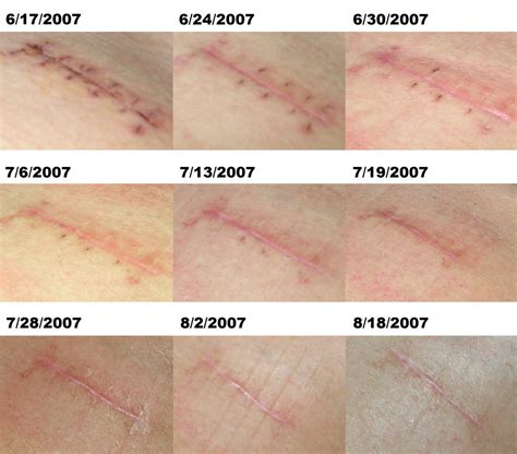 Quotes about Surgery scars (29 quotes)