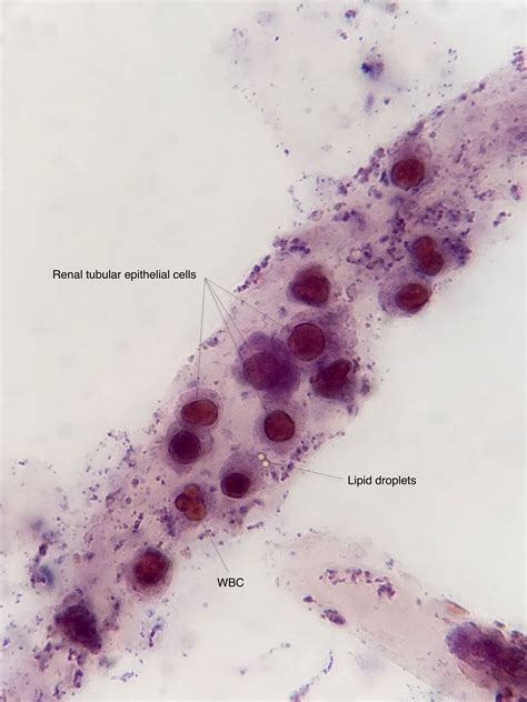 Urine Sediment Renal Cells