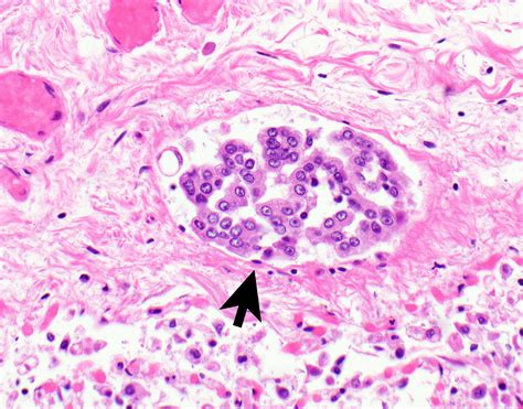 Epithelioid Mesothelioma Pathology Outlines - Goimages 411