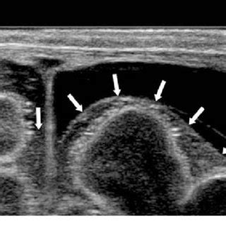 Coronal ultrasound section through the anterior fontanelle ...