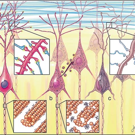 Morphological forms of neurofibrillary tangles (NFT) and progression ...