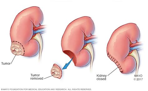 Nephrectomy (kidney removal) - Mayo Clinic